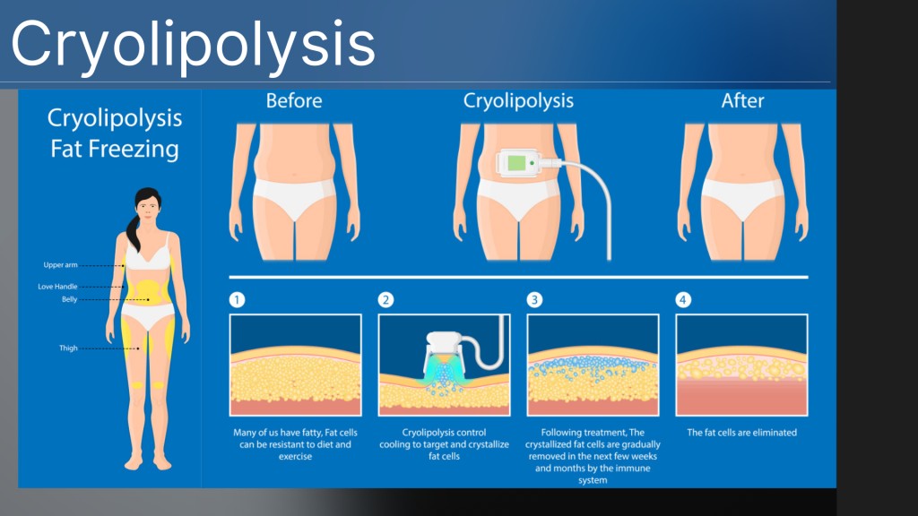 Cryolypolysis