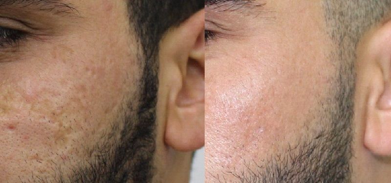 نانوفت چگونه می‌تواند به بهبود اسکار کمک کند؟